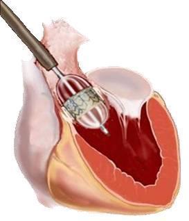 8. Implantatie via de grote lichaamslagader (transaortaal, TAo-AVI) Een transkatheter aortaklepimplantatie via de grote lichaamsslagader (aorta, transaortale ingreep) vindt plaats op de