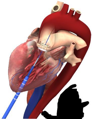 9. Implantatie via de punt van het hart (transapicaal, TA-AVI) Een transkatheter aortaklepimplantatie via de punt van het hart (apex, transapicale ingreep) vindt plaats op de hartkatheterisatiekamer.