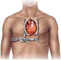2. Aortaklepvervanging door middel van openhartoperatie Een openhartoperatie is momenteel de standaard ingreep om de aortaklep te vervangen.