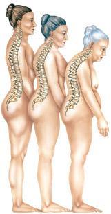 OSTEOPOROSE Osteoporose, wat is dat? Osteoporose betekent letterlijk poreus bot, ook wel botontkalking genoemd.