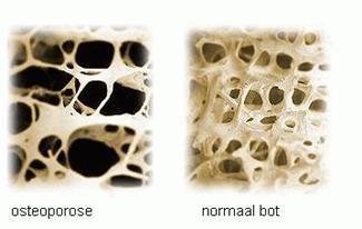 Osteoporose komt vaak voor bij vrouwen na de overgang, maar ook oudere mannen kunnen osteoporose krijgen.