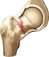 Verschijnselen van Osteoporose Osteoporose op zich geeft geen klachten. Als u een botbreuk oploopt kunnen wel pijnklachten ontstaan.