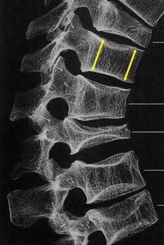 Botdichtheidsmeting Een botdichtheidsmeting (DEXA) is een onderzoek waarbij met röntgenstralen de dichtheid van uw botten wordt gemeten.