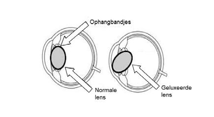 6 / Ogen De meest kenmerkende oogafwijking bij mensen met het Marfansyndroom is een verplaatsing van de ooglens (lensluxatie). Een oogarts kan lensluxatie vaststellen met een speciale lamp.