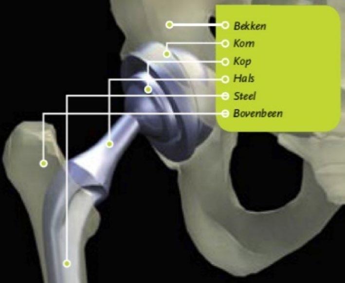 De kop en kom worden in het bot van uw dijbeen en bekken vastgeklemd, of met cement vastgezet (zie afbeelding). Wat is een DAA-operatie?