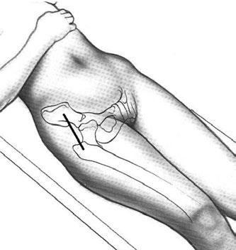 Deze operatie is bekend onder de volgende namen en afkortingen: DA (Direct Anterieur: direct van voren) MIA(S) (Minimal Invasive Anterior Surgery: minimaal invasieve anterieure benadering) AMIS