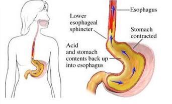 Refluxziekte Reflux = terugstromen van maaginhoud in slokdarm.