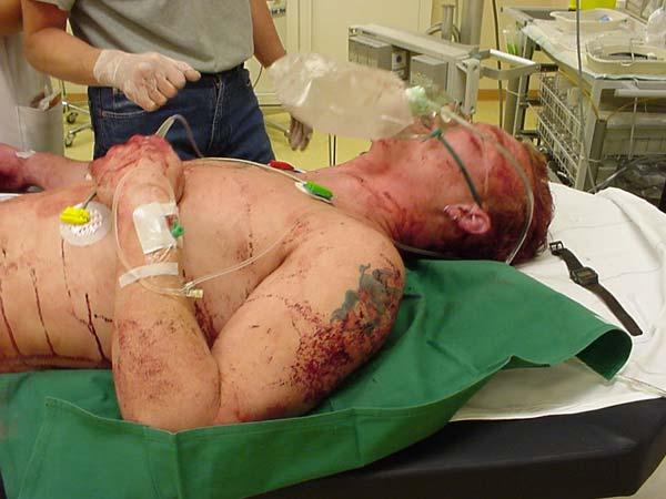 Van kop tot teen Meest gemiste letsels: Stomp abdominaal trauma: Holle