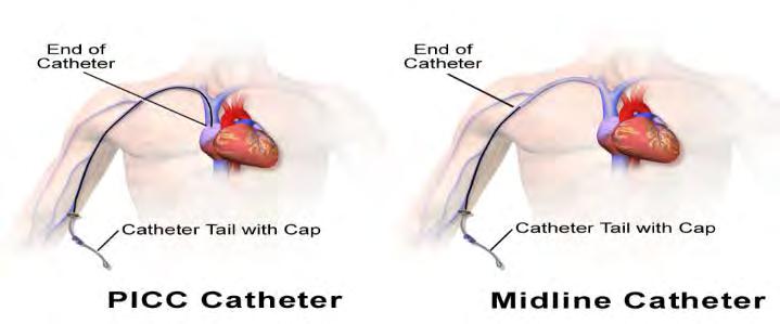 Soorten lijnen Perifeer (PVC): Perifere catheter