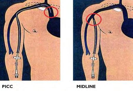 perifere vene) (duurt langer voordat medicijn in