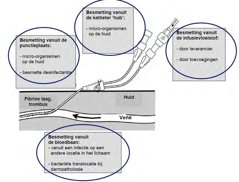 Preventie van CLABSI Hoe
