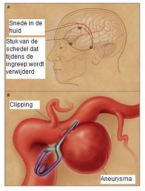 Bij de behandeling van een geruptureerd aneurysma is het de bedoeling om: 1) De bloeding te stoppen. 2) De complicaties van de bloeding te behandelen.