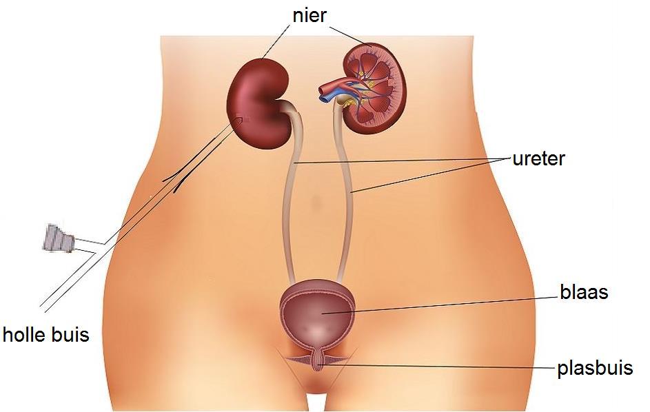 Katheters inbrengen Eerst ligt u op uw rug en kijkt de uroloog met een speciaal instrument via de plasbuis in uw blaas. Dit wordt een cystoscopie genoemd.