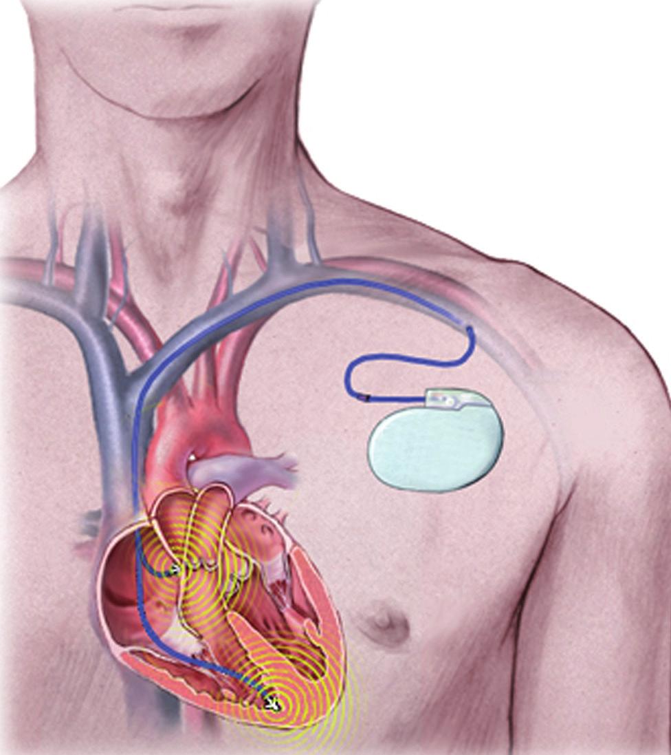 5 De normale hartslag bij een volwassene in rust ligt tussen de 50 à 100 slagen per minuut en kan bij inspanning oplopen tot 20