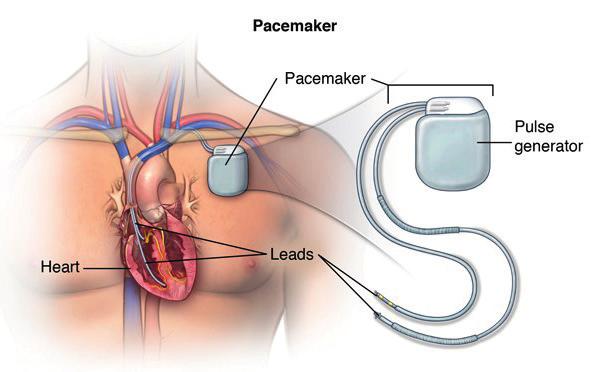 Beste patiënt, Binnenkort wordt u in het AZ Jan Palfijn Gent opgenomen voor een pacemaker. In deze brochure trachten we u zo duidelijk mogelijk uit te leggen wat dit inhoudt.
