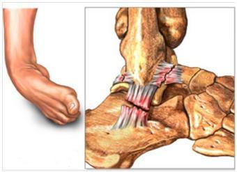 Enkelinstabiliteit Het enkelgewricht bestaat uit 3 botdelen: het scheenbeen (tibia), het kuitbeen (fibula) en het sprongbeen (talus).