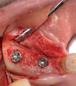 17: Tweedefasebehandeling drie maanden na membraanverwijdering. Het implantaat wordt zichtbaar nadat eerst hard regeneratieweefsel is verwijderd met roterend instrumentarium.