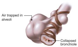 Verlies alveoli Chronische inflammatie (neutro s) Collaps bij expiratie Longfunctie Demografie Gering