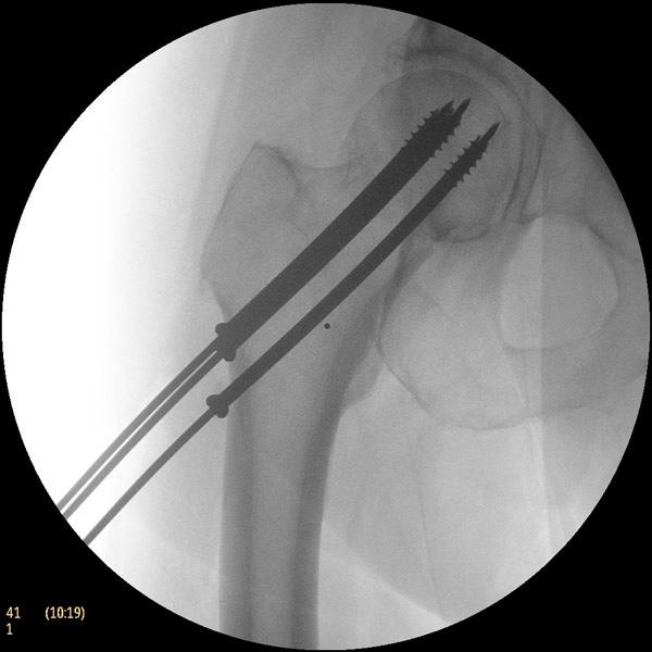 Soorten operatietechnieken De operatietechniek is onder andere afhankelijk van het soort fractuur.