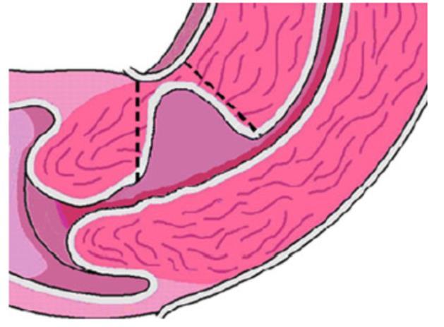 Schematische weergave van een niche, Niche tijdens echoscopie, gepubliceerd in Vervoort gepubliceerd in Vd Voet et al, BJOG 2014 [9] et al.