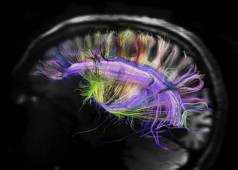 Fasciculus longitudinalis superior Frontaal