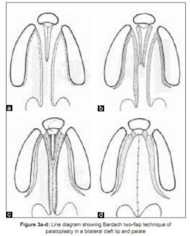 Tabel 1: Overzicht van de voornaamste technieken voor verhemeltesluiting (hard en/of zacht verhemelte) (Moore, Lawrence, Ptak & Trier, 1988; Leow & Lun-Jou, 2007; Agrawal, 2009; Wiet, Biavati &