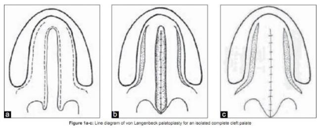 Voordelen: eenvoud en minder dissectie Nadelen: anterieure fistula s; geen verlenging van het palatum (inferieure spraak); luchtwegobstructie tijdens spraak.