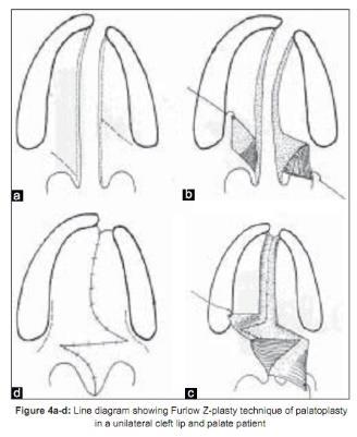 Sluiting van het zachte verhemelte Palatoplastiek volgens Kenmerkend aan de techniek: orale en Furlow nasale musculomucosale flappen worden (double opposing Z- posterieur gebracht, orale en nasale