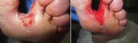 Granulox in de klinische praktijk Casus: veneus ulcus Man, 43 jaar, al 8 jaar last van