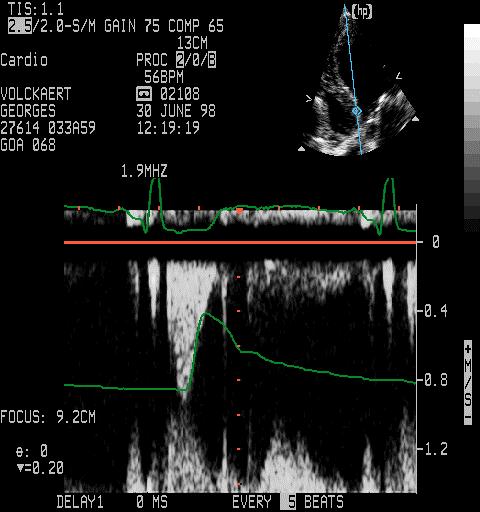 CHAPTER 2 CWD PWD CMD 2D Figure 2.7: Doppler echocardiographic modes.