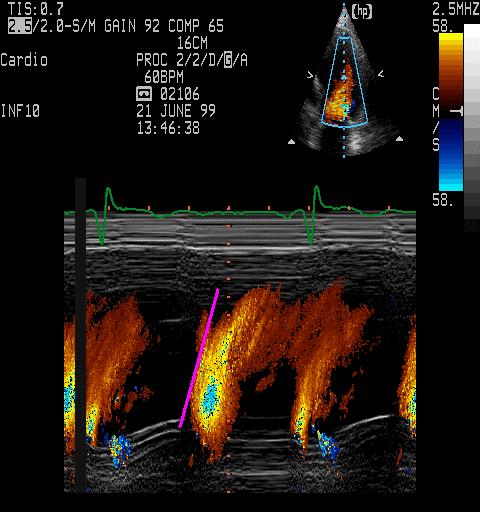 aortic valve flow, Pulsed wave Doppler (PWD) of mitral valve flow, Color M-mode