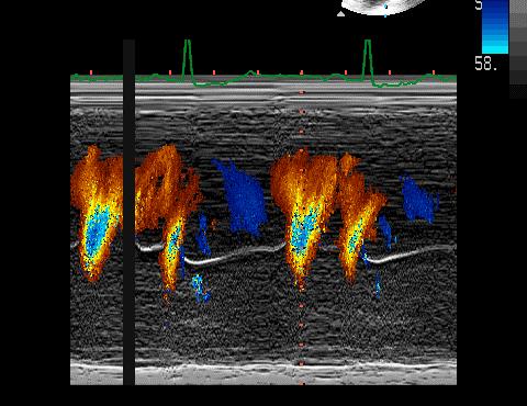 ASSESSMENT OF THE LV FLOW PROPAGATION VELOCITY 1.