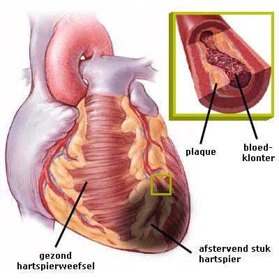Hart- en vaatziekten Hartinfarct een hartinfarct is een afsluiting