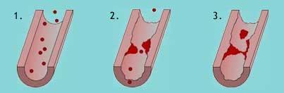 Hart- en vaatziekten Trombose vernauwing slagader door bloedpropje