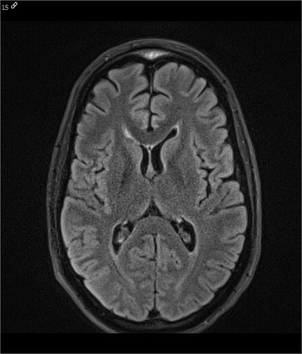 Een 3T MR-hersenen met optimaal epilepsieprotocol kon geen posttraumatische restletsels aantonen 11 dagen na de epileptische aanvallen.