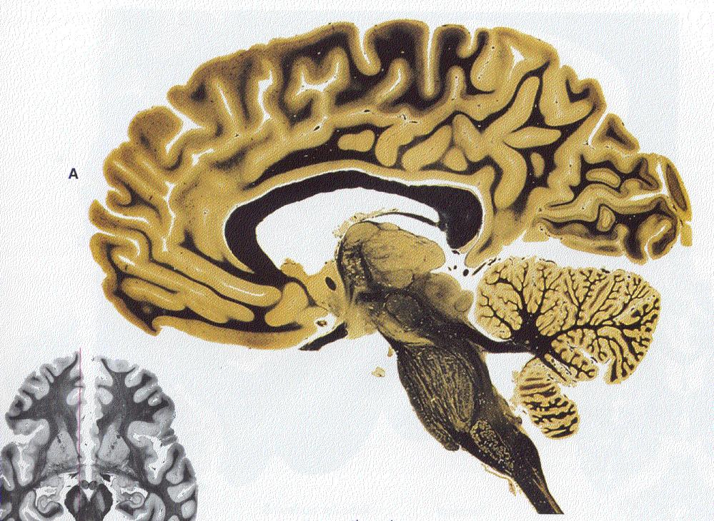 Anterior cingulate cortex (ACC) integrates cognitive & affective processes Cognitive regulator detects competition self-monitoring strategizing error detection problem solving Affective