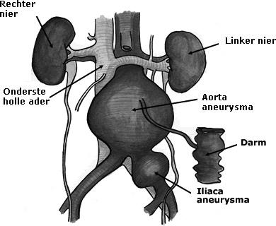1. Inleiding Bij u is een ernstige verwijding van uw buikslagader (aorta) ontdekt. Binnenkort wordt deze verwijding tijdens een operatie verholpen.