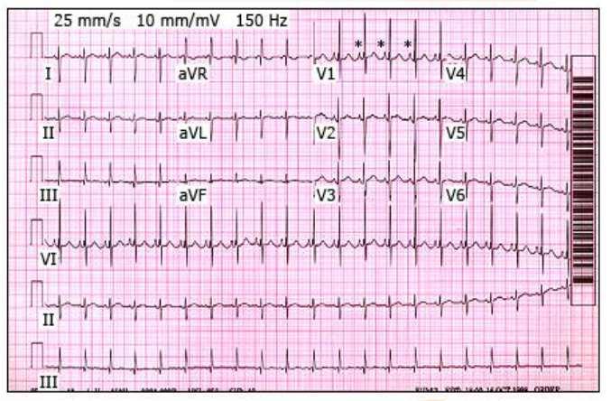 Casus 1 ECG ECG Prominente *P toppen in V1 passend bij RA vergroting.