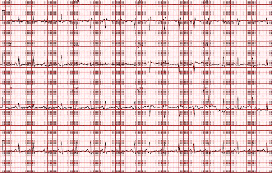 Casus 2 ECG Sinusritme, 107/min, normale as, incomplete RBTB, lang QTc, aspecifieke repolarisatiestoornissen 25 Casus 2 Vraag psychiater: Patiente is depressief, gaat klin achteruit, wil starten met