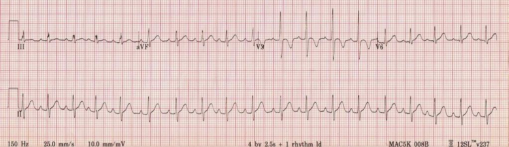 Normaal ECG kind Heart rate of 110 bpm (normal for age).