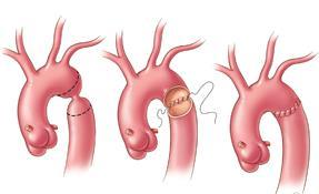 Chirurgische therapie Coarctectomie Subclavian flap-operatie