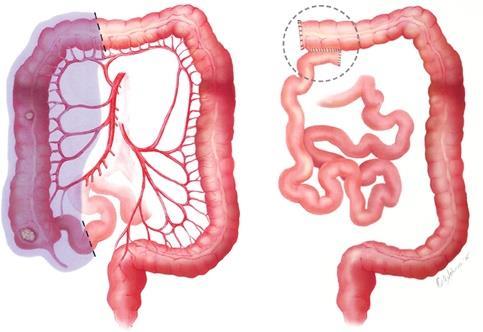 Casus inflammatoire pijn 31-jarige man Rechter hemicolectomie (ziekte van Crohn) Naadlekkage revisie: diagnostische laparotomie Infectieus beeld (CRP, koorts)