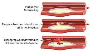 Pijn/druk op de