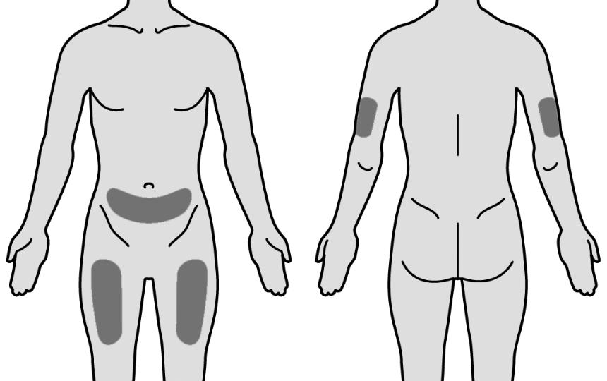 Subcutane (onderhuidse) route: Als u geadviseerd wordt MIRCERA te injecteren onder uw huid, dien dan de dosis toe zoals hieronder beschreven.