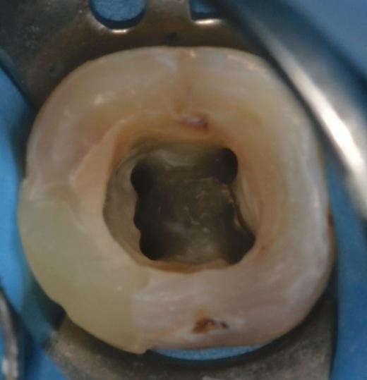 Krasner P, Rankow J (2004) Anatomy of the pulp- chamber floor.