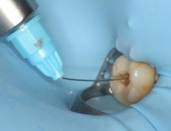 outcome as compared to the same procedures performed without magnifiers.