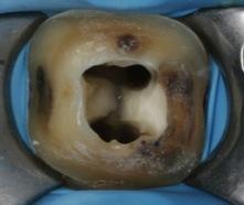 infec-on root fracture