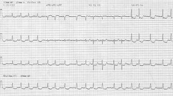 VRAAG EN ANTWOORD Cordiaal 2006:5:167 167 Een consult van de chirurg Wat ziet u op het elektrocardiogram?