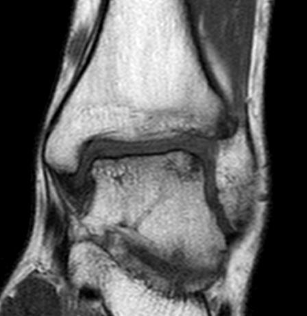 Osteoarthr. Cartilage, 2005; 13:582-588; Marijnissen ACA, et al. J Orth Res.