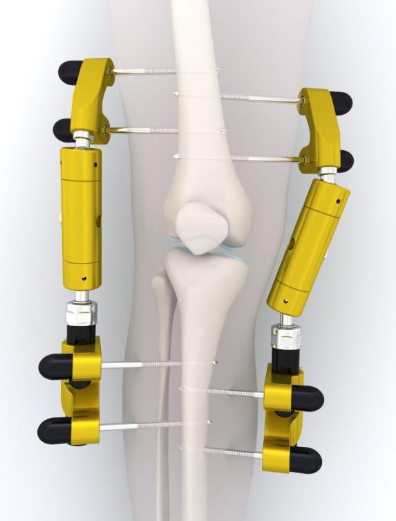 Knie distractie: uitstel 1 e prothese: ~45 min chirurgische behandeling 2-3 dagen